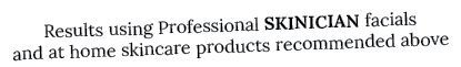 Results using Professional SKINICIAN facials and at home skincare products recommended above